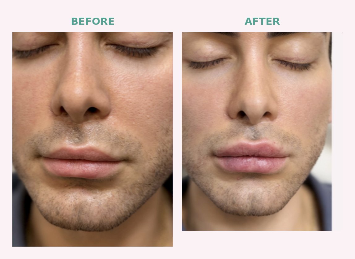Lip Filler at Serene Med Spa