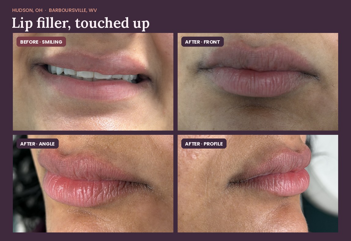 Before and after photos of a Juvederm Volbella XC lip filler touch-up at Serene Med Spa, cropped to the lips