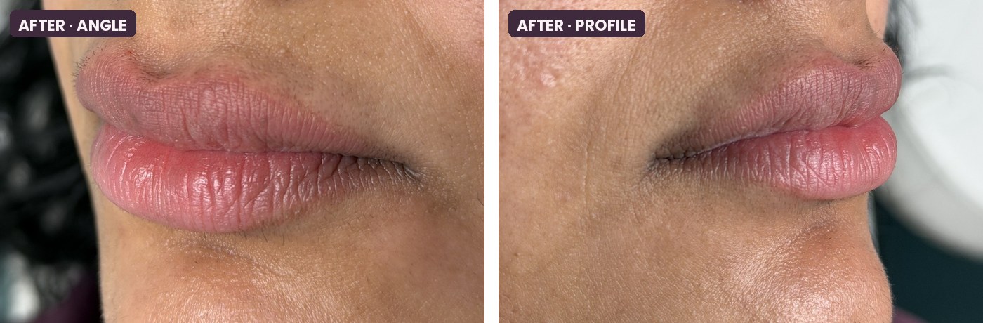 After a Volbella XC lip touch-up, angled and profile views of the lips