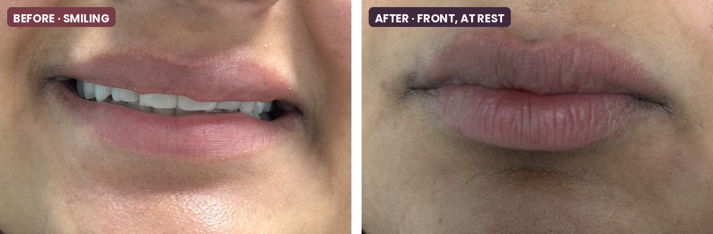 Before and after lip filler touch-up with Volbella XC, cropped to the lips: before while smiling and after at rest