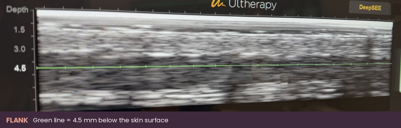 Ultherapy DeepSEE ultrasound image of the flank, the love handle area, with the green line at 4.5 mm below the skin surface