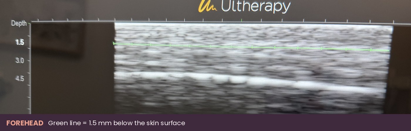 Ultherapy DeepSEE ultrasound of the forehead with the green focal line at 1.5 mm below the skin surface