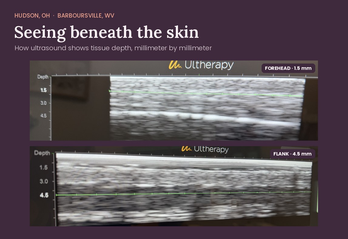 Ultherapy DeepSEE ultrasound images from Serene Med Spa showing the forehead at a 1.5 mm focal depth and the flank at a 4.5 mm focal depth